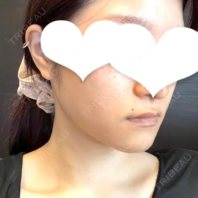 ボトックス（エラ・小顔） LOUIS CLINIC 二子玉川院【ルイクリニック】 DAY 6 メイン用