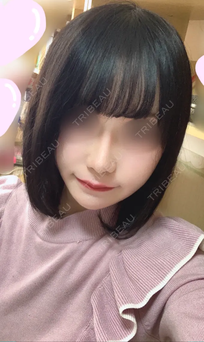 隆鼻術 / 鼻中隔延長（切開） / 小鼻縮小（切開） / 軟骨移植 / ワシ鼻修正・ハンプ切除 加美（GAMI）整形外科 AFTER メイン用