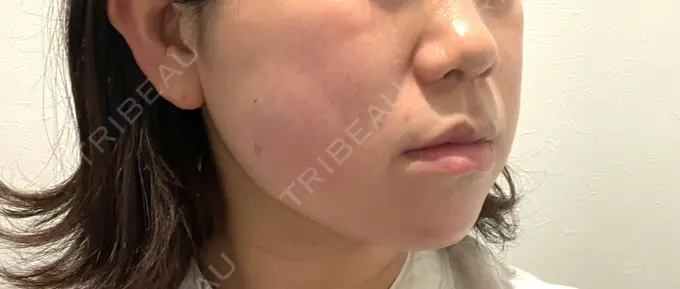 脂肪溶解注射（顔） / ハイフ（顔） ネビュラクリニック 広島院 DAY 0 メイン用