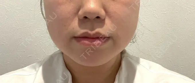 脂肪溶解注射（顔） / ハイフ（顔） ネビュラクリニック 広島院 DAY 19 メイン用