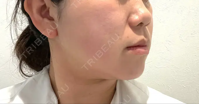 脂肪溶解注射（顔） / ハイフ（顔） ネビュラクリニック 広島院 DAY 19 メイン用