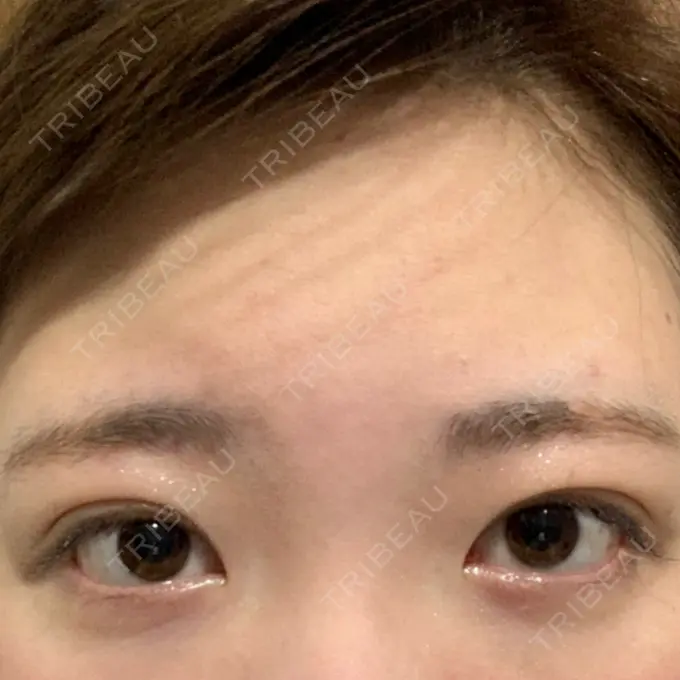 二重埋没 グランメドクリニック茨木 AFTER メイン用