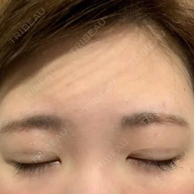 二重埋没 グランメドクリニック茨木 DAY 21 メイン用