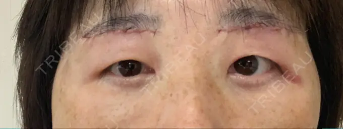 眉下切開 みずほクリニック DAY 1 メイン用