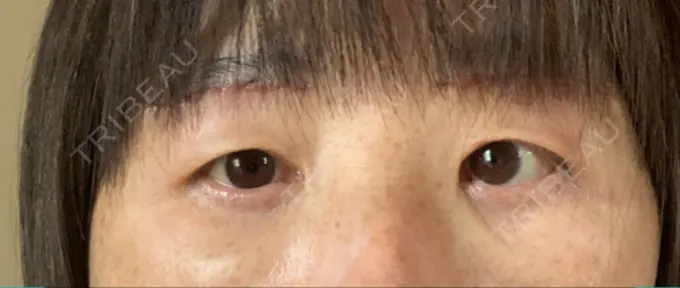 眉下切開 みずほクリニック DAY 2 メイン用