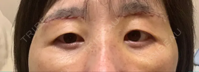 眉下切開 みずほクリニック DAY 3 メイン用