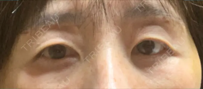 眉下切開 みずほクリニック DAY 7 メイン用