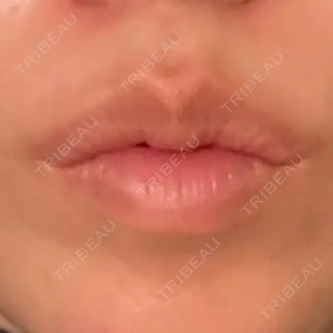 ヒアルロン酸注入（唇） / ボトックス（口角） アリエル美容クリニック 郡山院 AFTER メイン用