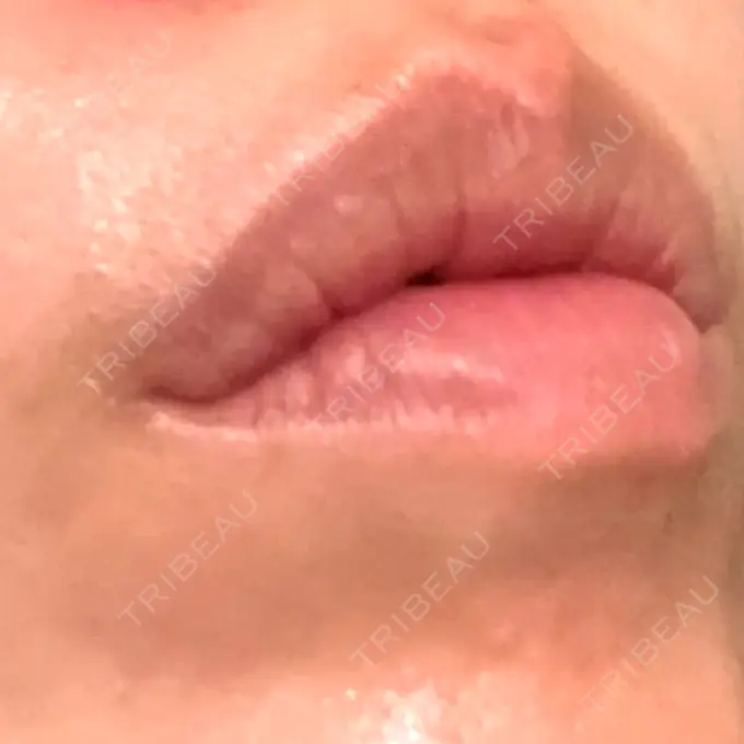 ヒアルロン酸注入（唇） / ボトックス（口角） アリエル美容クリニック 郡山院 DAY 10 メイン用