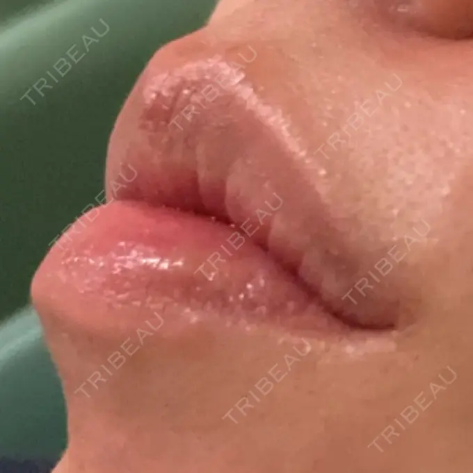 ヒアルロン酸注入（唇） / ボトックス（口角） アリエル美容クリニック 郡山院 DAY 10 メイン用