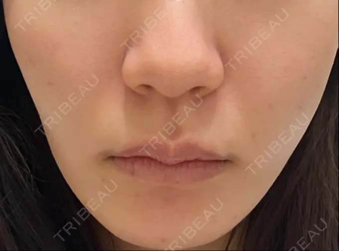 脂肪溶解注射（顔） 東京たかはしクリニック 練馬院 DAY 0 メイン用