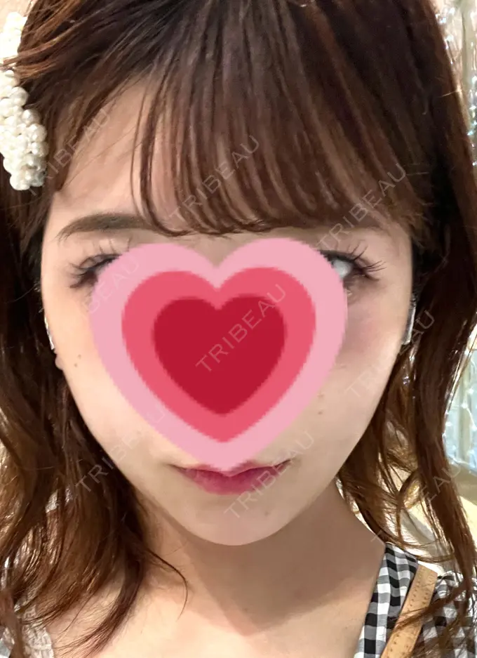 脂肪吸引（顔） / ジョールファット除去 / ボトックス（エラ・小顔） Otus Clinic 【オータスクリニック】 DAY 69 メイン用