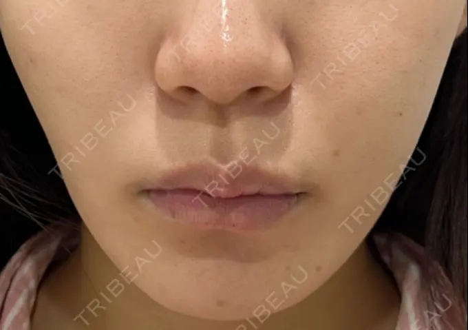 脂肪溶解注射（顔） 東京たかはしクリニック 練馬院 DAY 1 メイン用