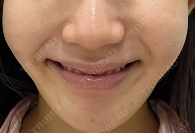 脂肪溶解注射（顔） 東京たかはしクリニック 練馬院 DAY 1 メイン用