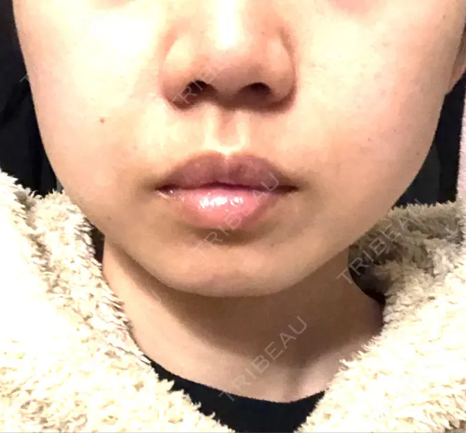 ボトックス（エラ・小顔） 仙台TAクリニック DAY 7 メイン用