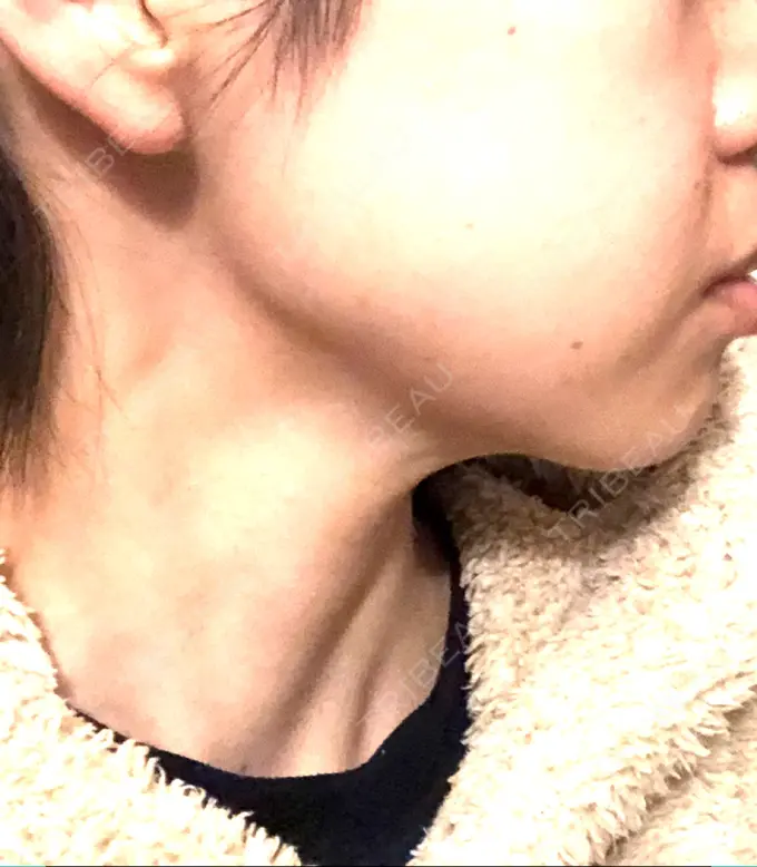 ボトックス（エラ・小顔） 仙台TAクリニック DAY 7 メイン用