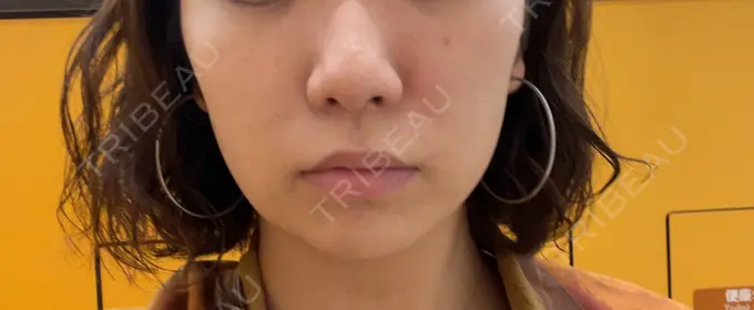 脂肪吸引（顔） / 下まぶたたるみ取り / メーラーファット除去 WOM CLINIC GINZA （ワム クリニック ギンザ） AFTER メイン用