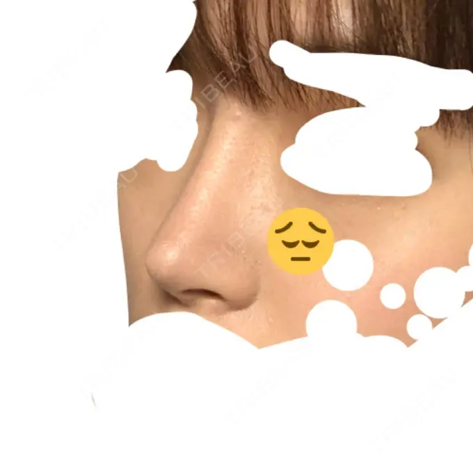 隆鼻術 / 軟骨移植 / プロテーゼ除去 FROM B整形外科 (旧バウム整形外科) DAY 247 メイン用