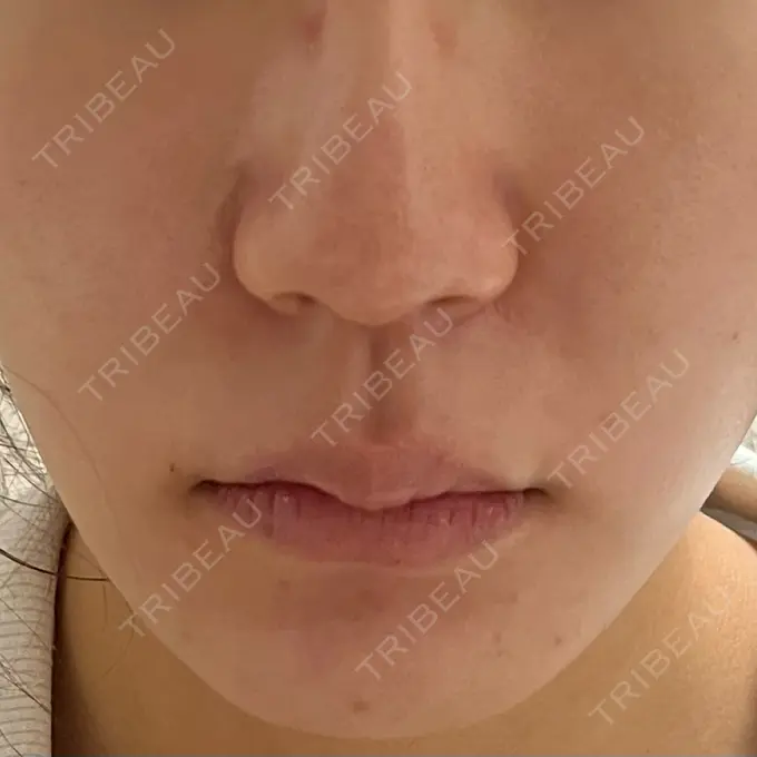 脂肪溶解注射（顔） 東京たかはしクリニック 練馬院 DAY 2 メイン用