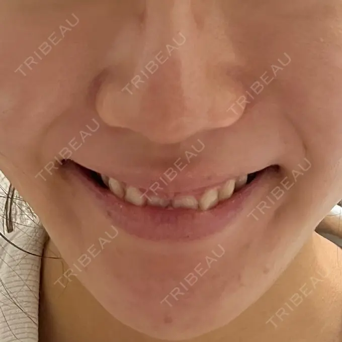 脂肪溶解注射（顔） 東京たかはしクリニック 練馬院 DAY 2 メイン用