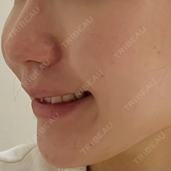 脂肪溶解注射（顔） 東京たかはしクリニック 練馬院 DAY 2 メイン用