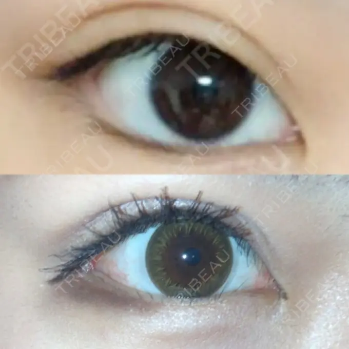 目尻切開 / タレ目形成・グラマラスライン（切開） / 目尻靭帯移動 FROM B整形外科 (旧バウム整形外科) DAY 36 メイン用