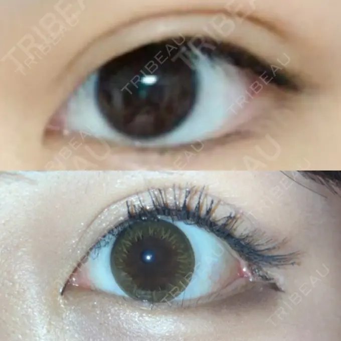 目尻切開 / タレ目形成・グラマラスライン（切開） / 目尻靭帯移動 FROM B整形外科 (旧バウム整形外科) DAY 36 メイン用