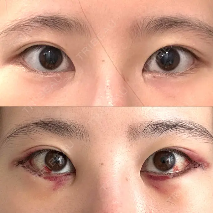 タレ目形成・グラマラスライン（切開） 銀座マイアミ美容外科 DAY 3 メイン用