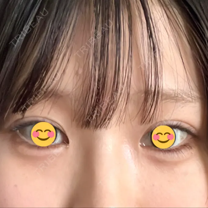 ヒアルロン酸注入（涙袋） 吉祥寺アイビークリニック AFTER メイン用