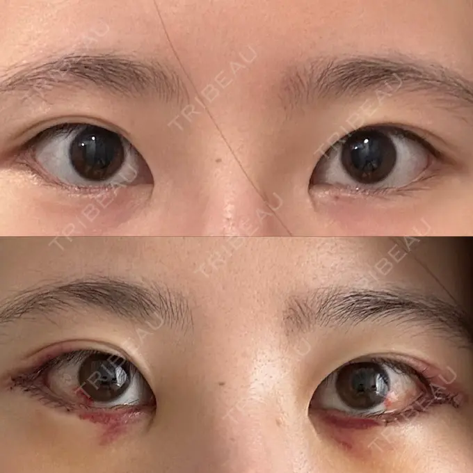 タレ目形成・グラマラスライン（切開） 銀座マイアミ美容外科 DAY 4 メイン用