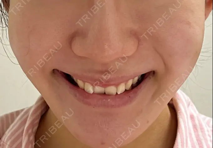 脂肪溶解注射（顔） 東京たかはしクリニック 練馬院 AFTER メイン用