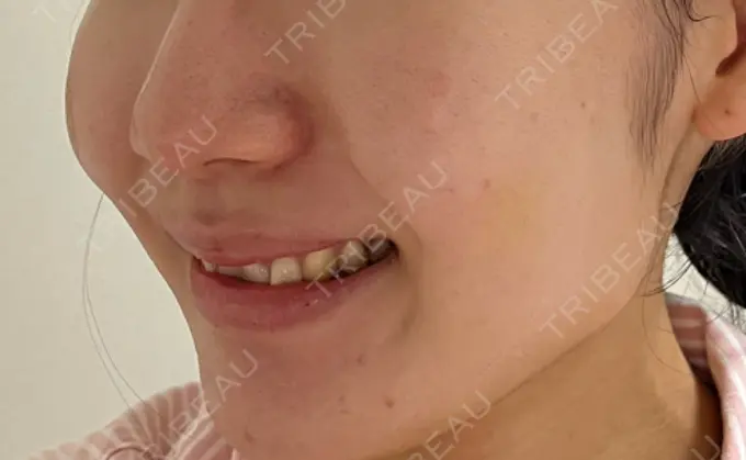 脂肪溶解注射（顔） 東京たかはしクリニック 練馬院 DAY 4 メイン用