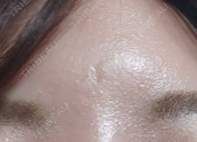 傷跡修正 / 傷跡修正 TETSU形成・美容クリニック AFTER メイン用