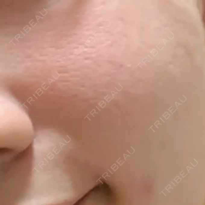 その他（肌） メディアージュクリニック 青山院 DAY 11 メイン用