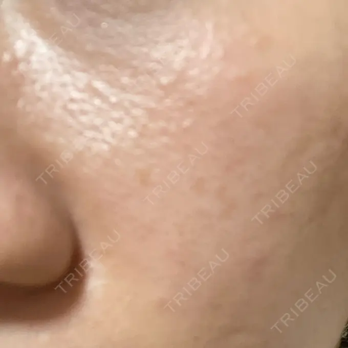 その他（肌） メディアージュクリニック 青山院 DAY 15 メイン用