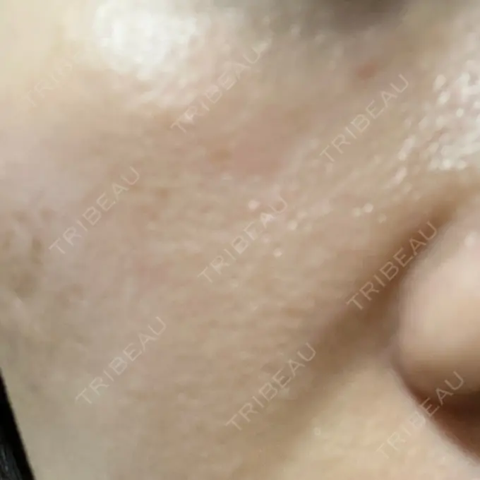 その他（肌） メディアージュクリニック 青山院 AFTER メイン用