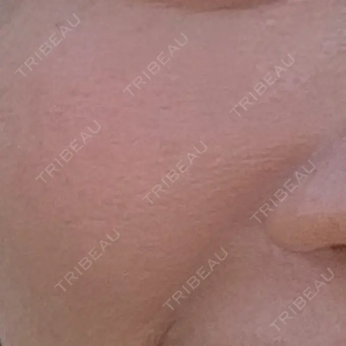 その他（肌） メディアージュクリニック 青山院 DAY 12 メイン用