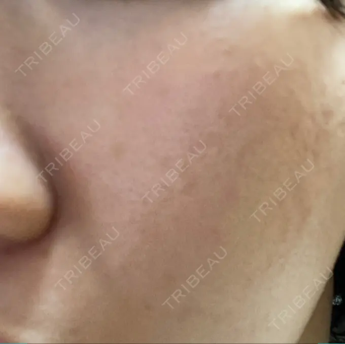 その他（肌） メディアージュクリニック 青山院 DAY 14 メイン用