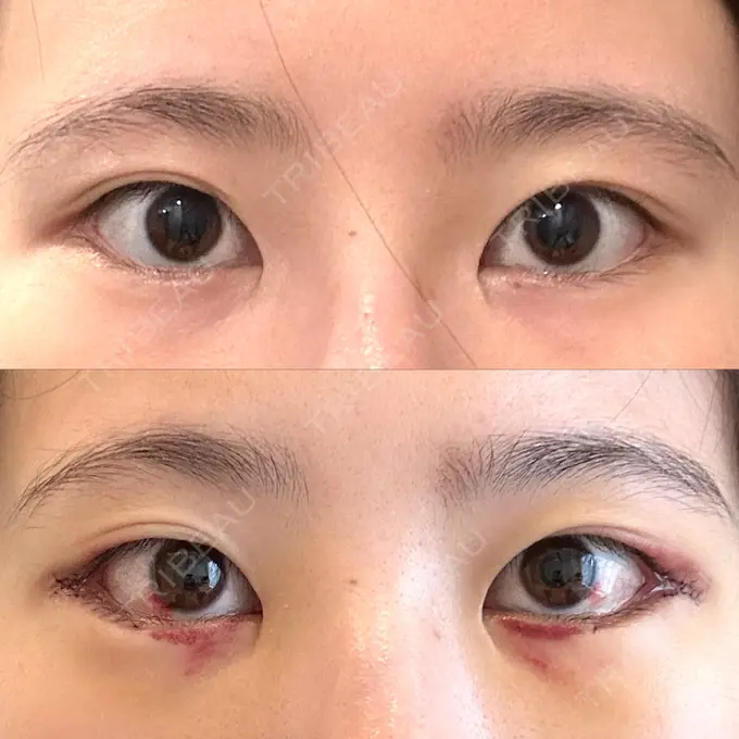 タレ目形成・グラマラスライン（切開） 銀座マイアミ美容外科 DAY 5 メイン用