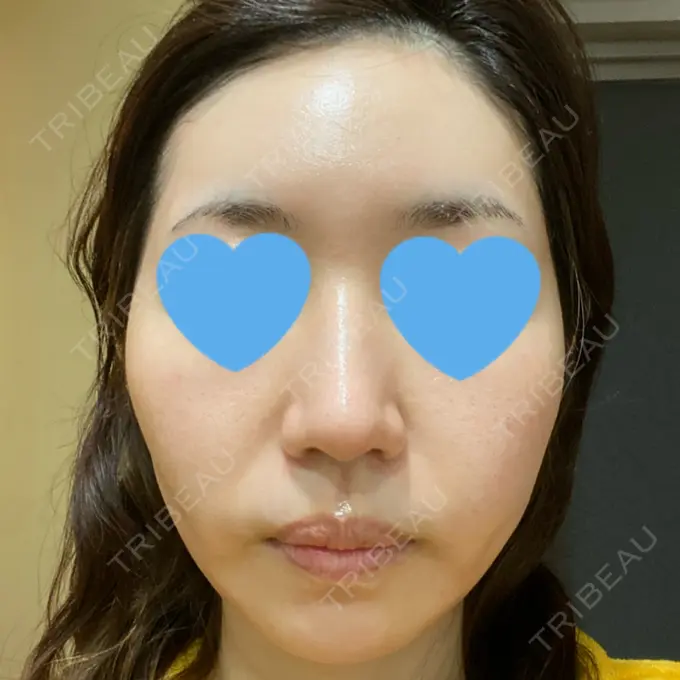 ポテンツァ LOUIS CLINIC 二子玉川院【ルイクリニック】 DAY 2 メイン用