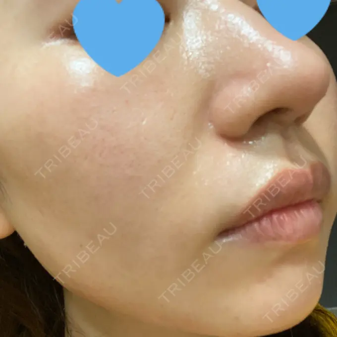 ポテンツァ LOUIS CLINIC 二子玉川院【ルイクリニック】 DAY 2 メイン用