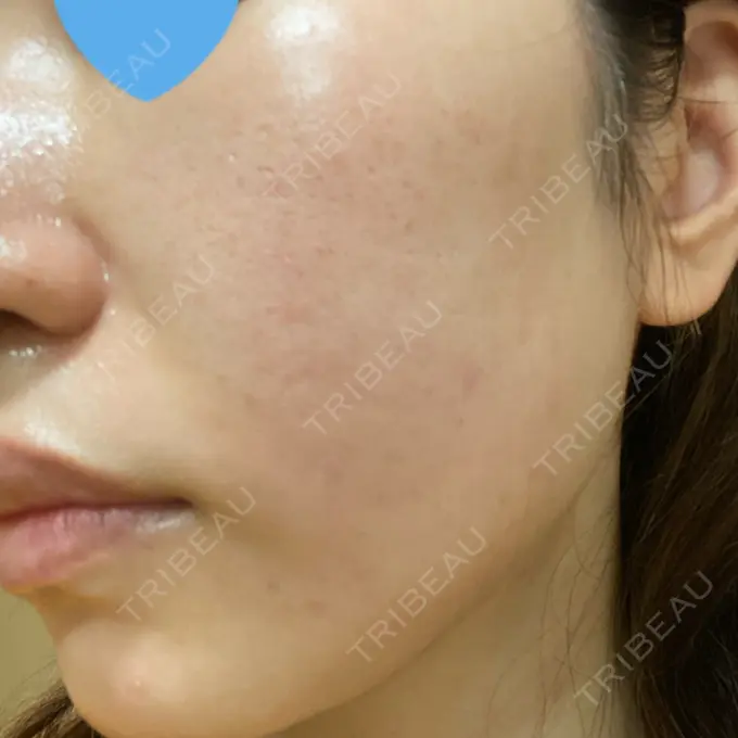 ポテンツァ LOUIS CLINIC 二子玉川院【ルイクリニック】 DAY 2 メイン用