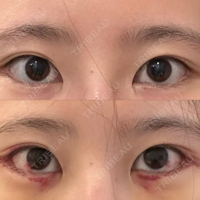 タレ目形成・グラマラスライン（切開） 銀座マイアミ美容外科 DAY 5 メイン用