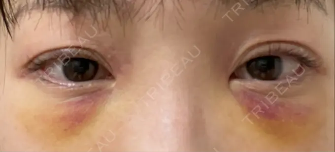 クマ治療 / 下まぶたたるみ取り / 脂肪注入（目の下） セオリークリニック DAY 3 メイン用