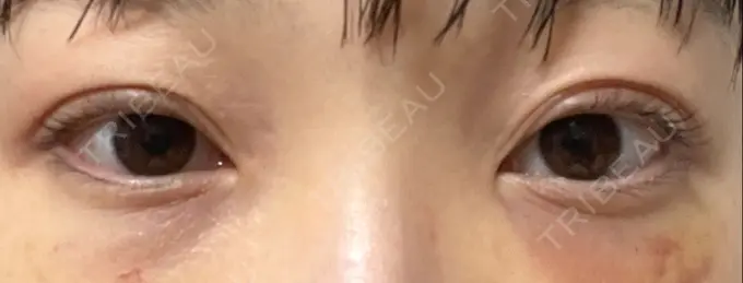 クマ治療 / 下まぶたたるみ取り / 脂肪注入（目の下） セオリークリニック DAY 7 メイン用