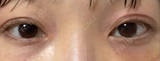 クマ治療 / 下まぶたたるみ取り / 脂肪注入（目の下） セオリークリニック DAY 14 メイン用