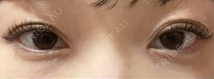 クマ治療 / 下まぶたたるみ取り / 脂肪注入（目の下） セオリークリニック DAY 14 メイン用