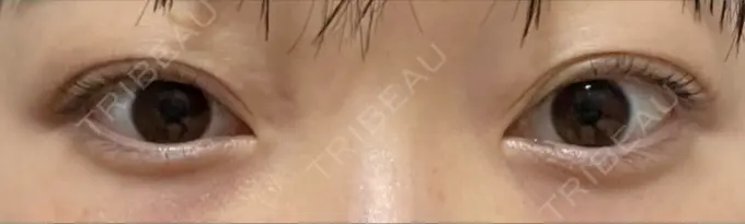 クマ治療 / 下まぶたたるみ取り / 脂肪注入（目の下） セオリークリニック DAY 59 メイン用