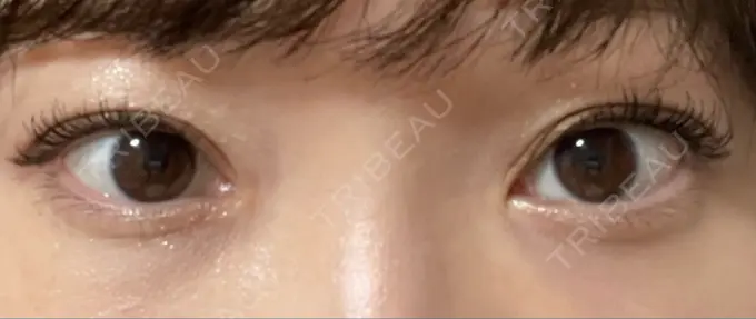 クマ治療 / 下まぶたたるみ取り / 脂肪注入（目の下） セオリークリニック DAY 59 メイン用