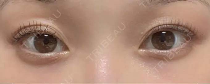 クマ治療 / 下まぶたたるみ取り / 脂肪注入（目の下） セオリークリニック AFTER メイン用